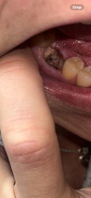 Dry socket and infection