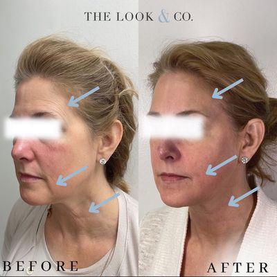 After two Morpheus8 treatments and botox to upper face to increase skin quality and laxity.