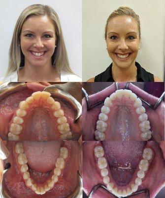 A beautiful smile created by using Invisalign clear aligners!