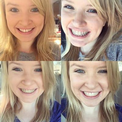 Dr. Eric and his staff's fantastic orthodontics skills made my teeth look amazing! (This entire process only took 6 months, as well)