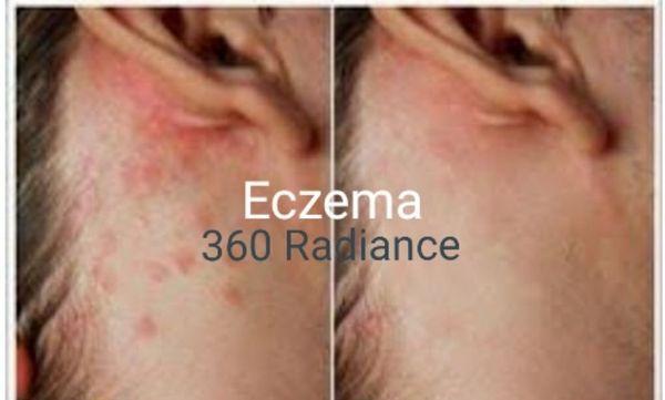 CLEAR ECZEMA AT 360 RADIANCE