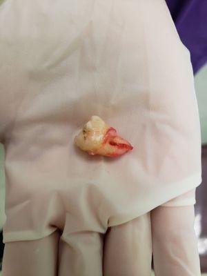 My giant wisdom tooth