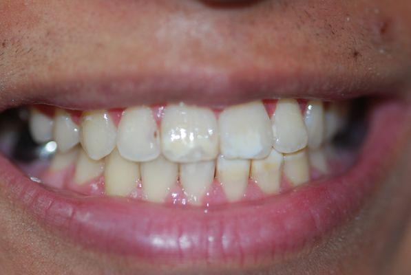 Before start of Veneers due to decalcification after ortho