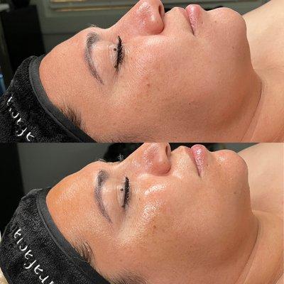 Exo Tech Mandelic Peel Before & Immediately After