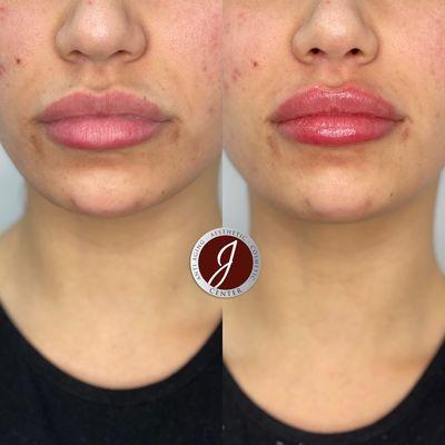 Lip Fillers done with Volbella