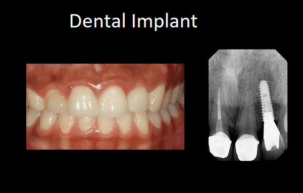 Dental implants can be used to predictably replace missing teeth.