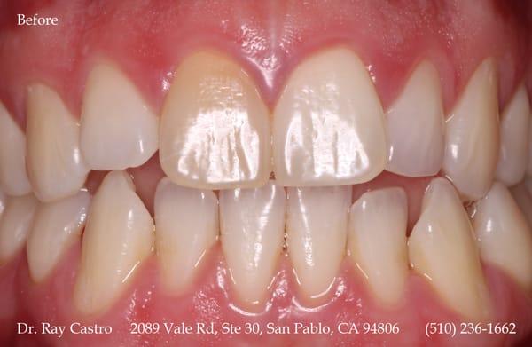 (before) Improving the color of a tooth with new dental materials. This is an actual patient of Dr. Castro.