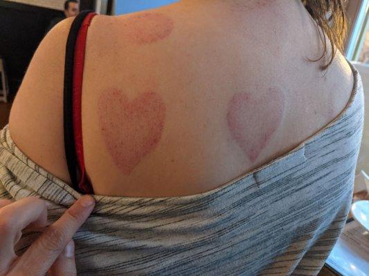 Heart shaped cupping therapy