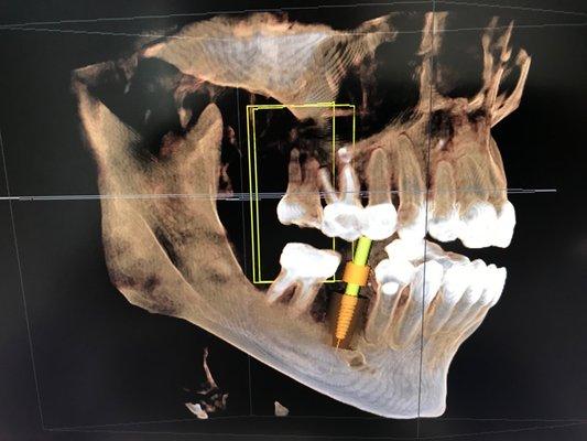 3D X-Ray