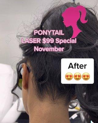 PONYTAIL LASER $99 NOVEMBER SPECIAL ‍