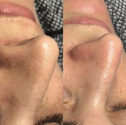 Deep pore clarifying facial