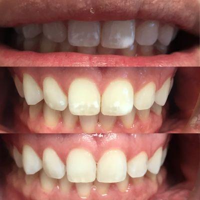 Pt. hated her white spot lesions from fluorosis. We were able to treat this conservatively with no shot, drilling, or filling! Woot Woot!