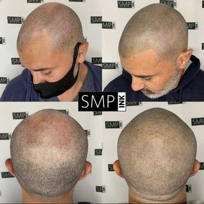 SMP (Scalp Micropigmentation)