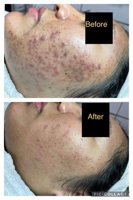 Acne facial