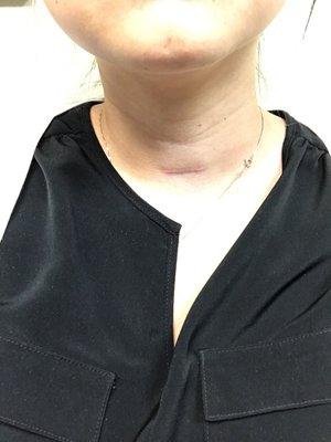 Minimally invasive total thyroidectomy scar