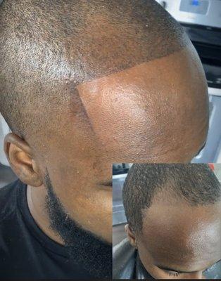 Hairline restoration