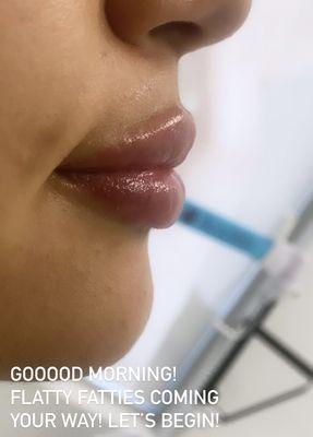 Fresh off the needle. Flat, natural and lifted!
 
 #lipfillers #juvederm #lipflip #russianlips #botox #BotoxInjection #botoxinjections