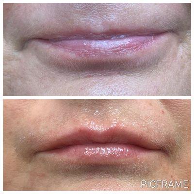 Fillers work best on the lip, the volume added to the upper lip took about 15 mins