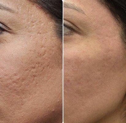 Before and After          Microneedling