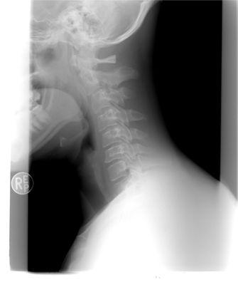 X-Ray