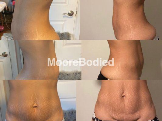 3 day Lipo laser results / Mommy make over