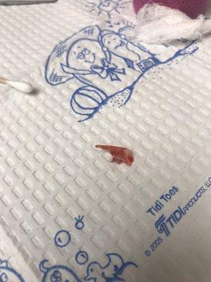 Ingrown tow nail