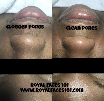 Before and after "Royal Facial"