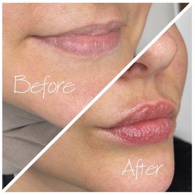 1ML Hyaluronic Acid Lip Filler  Natural Plump, Instant results, No downtime   Non-invasive, needle-less, Pain free