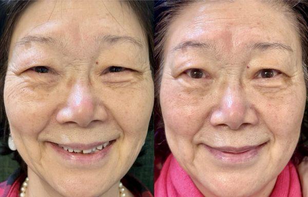 3D FaceLift Facial