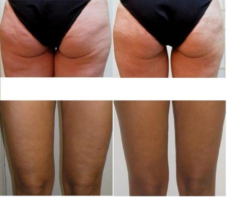 lost inch same day(ultrasound cavitation treatment) Fat& Cellulite removal