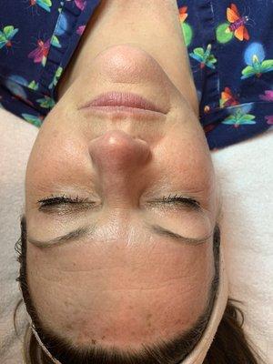 Beginning of Microneedling treatment