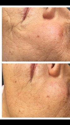 Effects of a microneedling treatment! Bottom is before, Top is after first session!