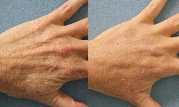 Before and after of hand rejuvenation with dermal fillers.