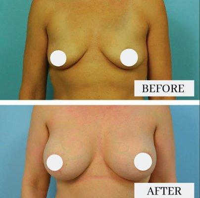 Breast Augmentation