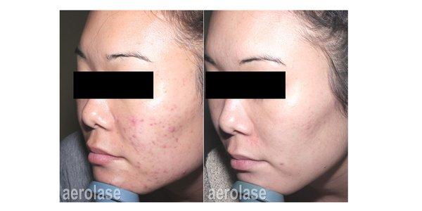 Acne laser treatment - after 6 sessions