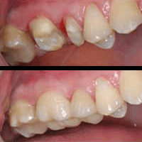 Before and after our cosmetic & emergency dentist work.