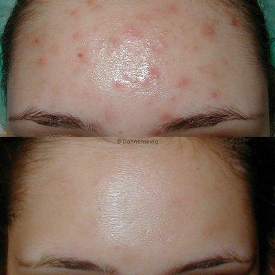 Some great before and after results with DMK! Wow!