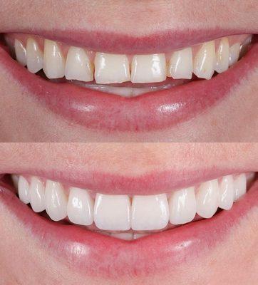 Veneers have achieved a beautiful, bright smile for this patient!  Misshaped and discolored teeth are easily corrected for a natural result.