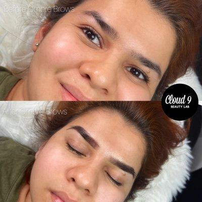 Before vs Immediately after procedure 
Instagram: @cloud9beautylab