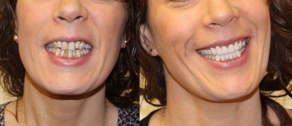 Smile makeover at our clinic