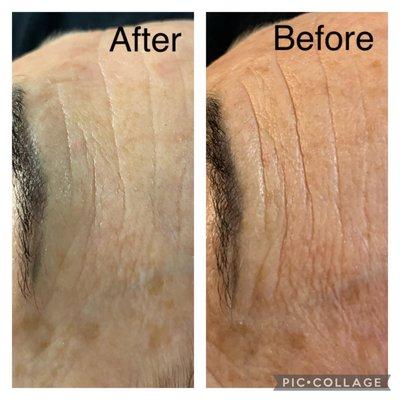 Beautiful skin plumping! One treatment with our BT Microcurrent and Peel Combo!