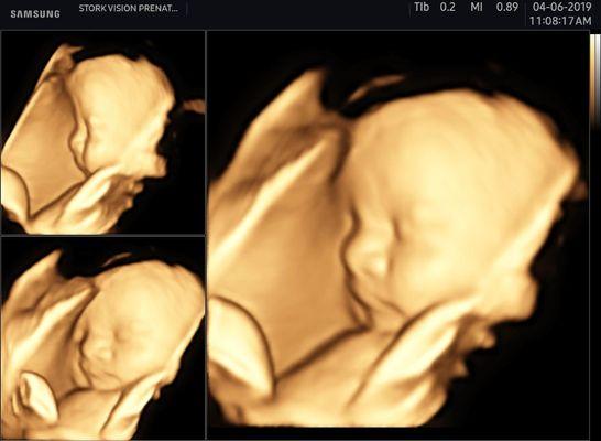 3D Ultrasound