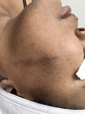 Dermaplaning facial