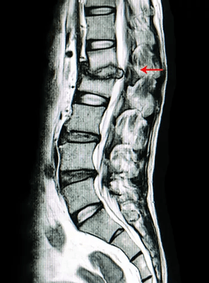 Spinal Decompression: Promotes the movement of water, oxygen, and nutrient-rich fluids into the disks so they can heal.