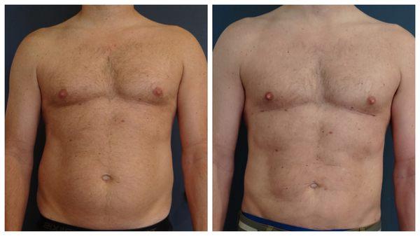 High definition liposuction, by Dr. Tim Neavin