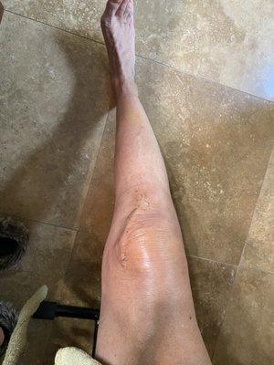 Three weeks post op, scar will be barely visible in a few months. Dr Mikulak said my new knee will last 35 years!