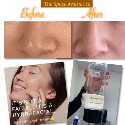 HydraFacial for deep cleaning face.