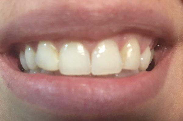 Before veneers (bad bonding done by other dentist on both lateral incisors- second teeth from middle)