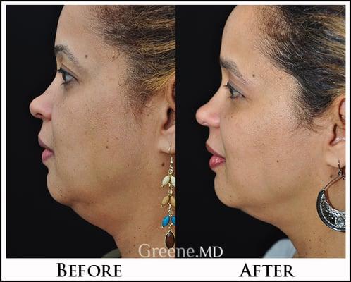 Improvement in jawline and neck just after one Ultherapy treatment to the area.