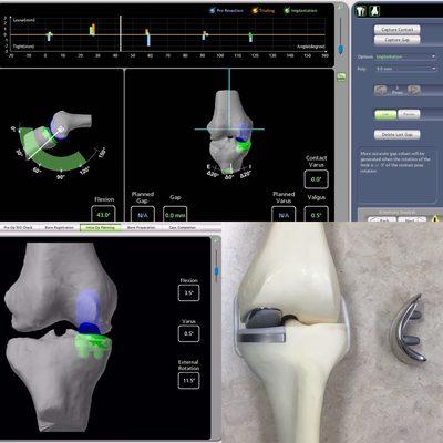 MAKO robotic assisted partial knee replacement!